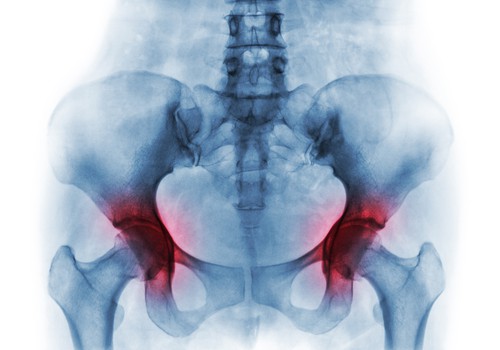 hip pain treatment